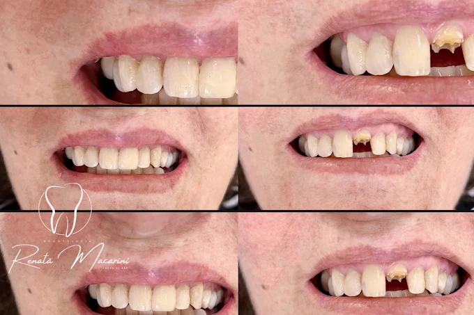 Grade de fotos de antes e depois de um caso de reabilitação estética dos dentes da frente, feito na Odontologia Renata Macarini